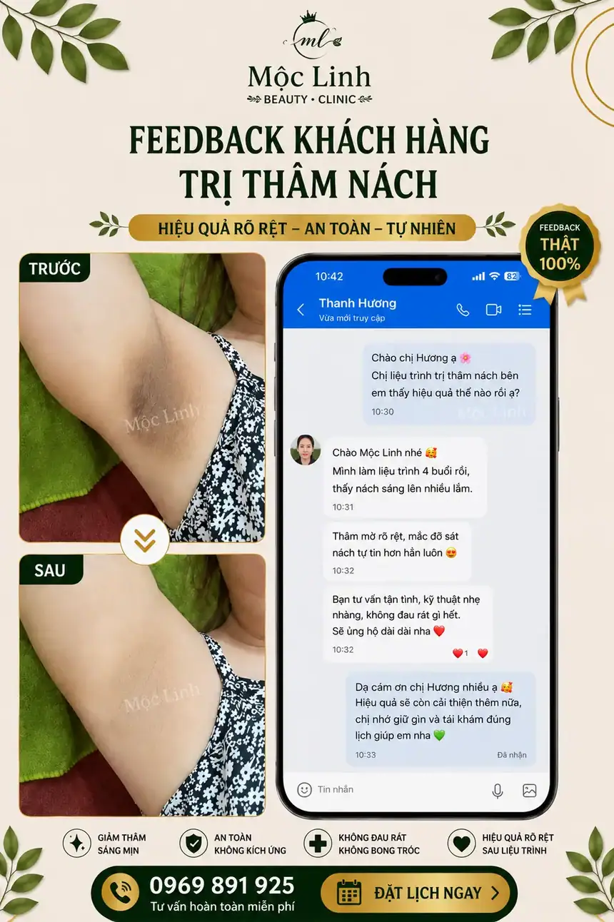 Trị thâm nách - bẹn Hải Phòng tại Thẩm Mỹ Mộc Linh - hình 6