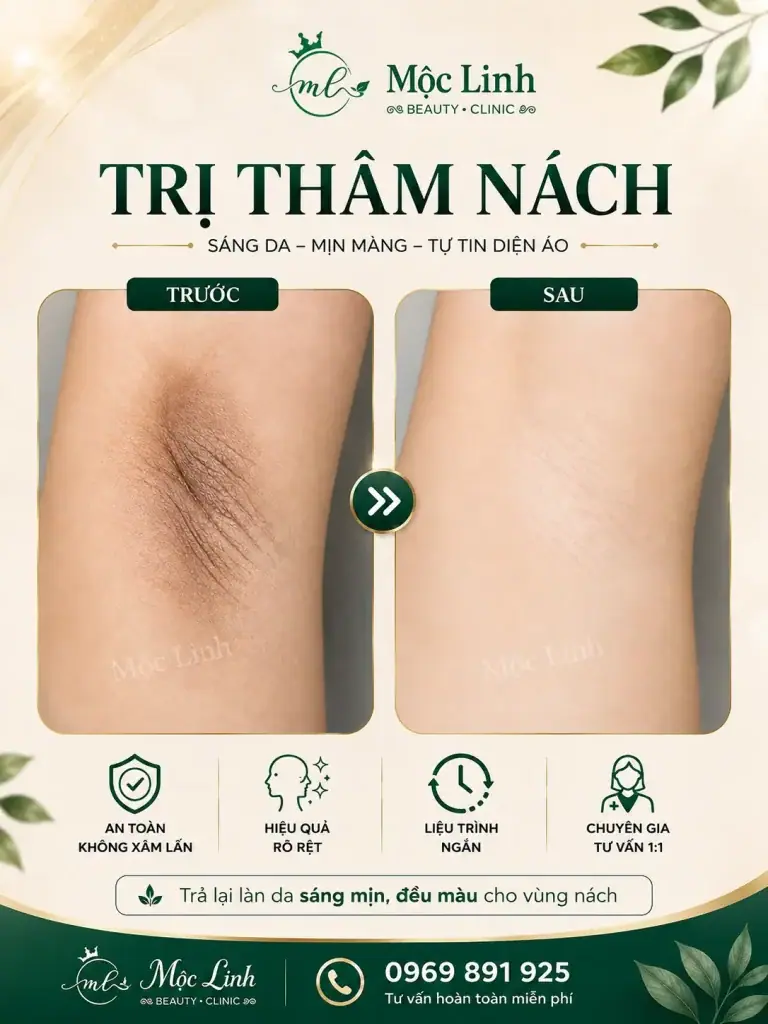 Trị thâm nách - bẹn Hải Phòng tại Thẩm Mỹ Mộc Linh - hình 8
