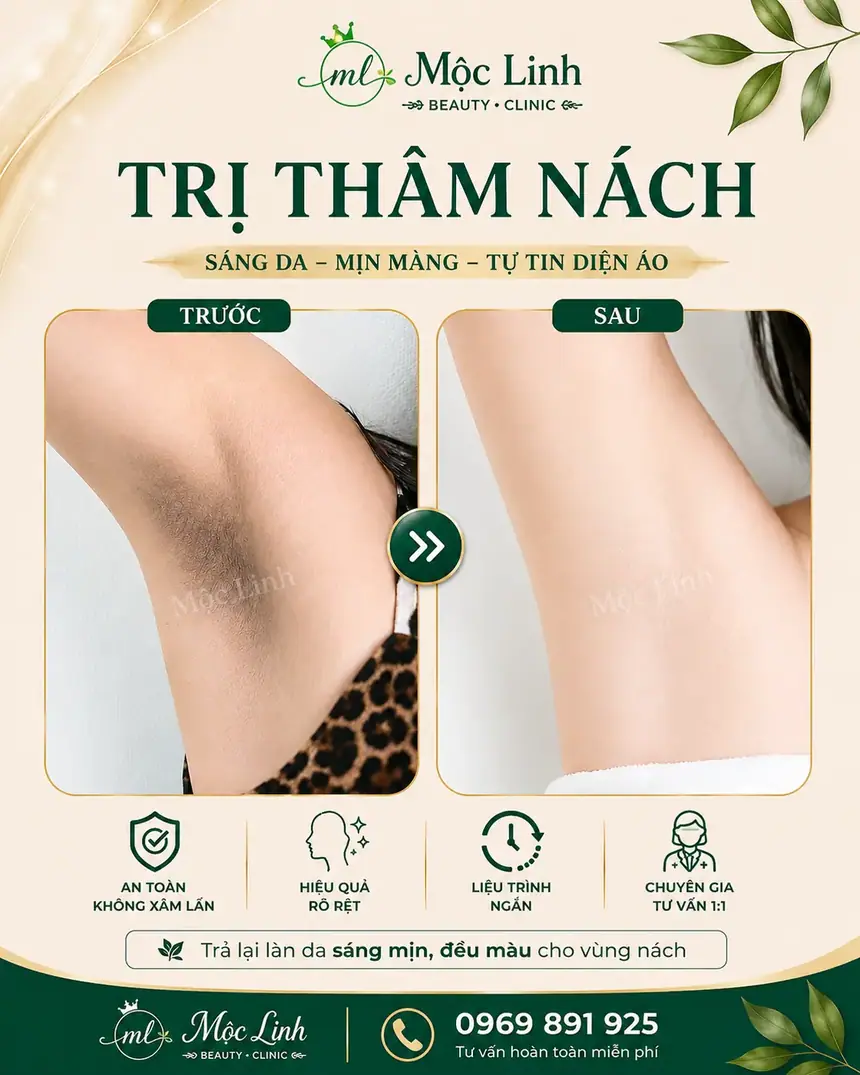 Trị thâm nách - bẹn Hải Phòng tại Thẩm Mỹ Mộc Linh - hình 3