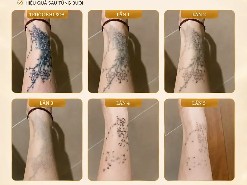 Xoá hình xăm Hải Phòng tại Thẩm Mỹ Mộc Linh - hình 4