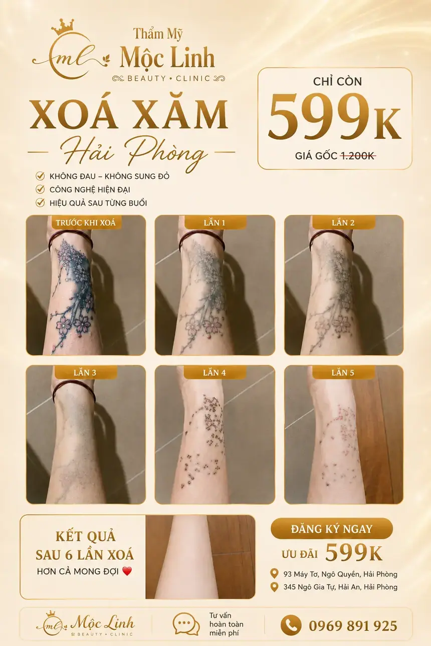 Xoá hình xăm Hải Phòng tại Thẩm Mỹ Mộc Linh - hình 6