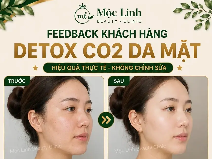 Detox CO2 Hải Phòng – Khi Làn Da Cần Được Làm Sạch Và tại Thẩm Mỹ Mộc Linh - hình 1