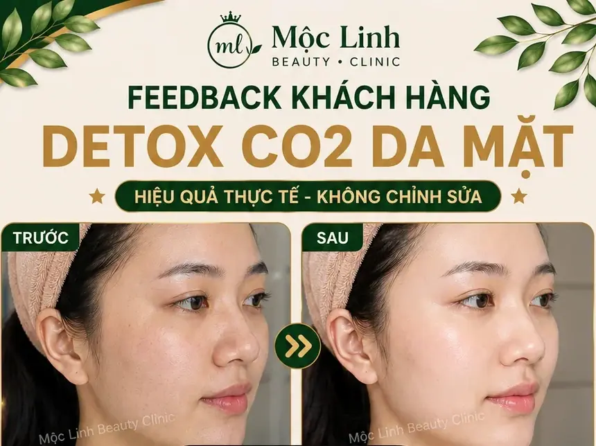 Detox CO2 Hải Phòng – Khi Làn Da Cần Được Làm Sạch Và tại Thẩm Mỹ Mộc Linh - hình 2
