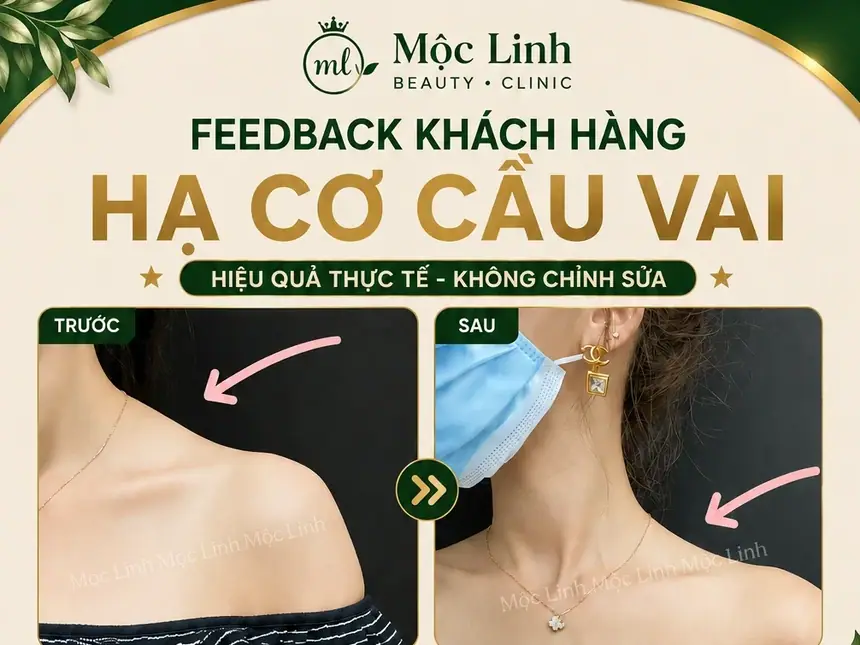 Tiêm Hạ Cơ Cầu Vai Hải Phòng tại Thẩm Mỹ Mộc Linh - hình 1