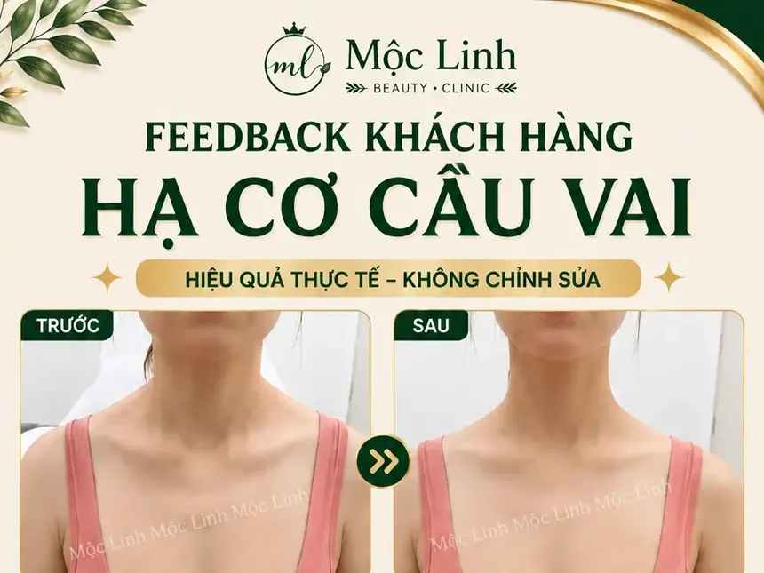 Tiêm Hạ Cơ Cầu Vai Hải Phòng tại Thẩm Mỹ Mộc Linh - hình 2