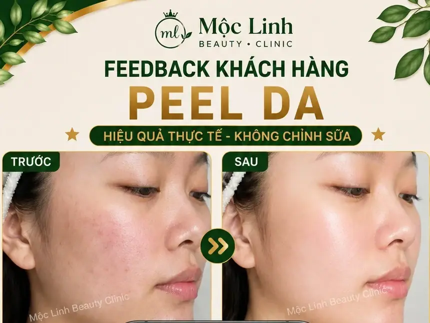 Peel Da Hải Phòng – Làn Da Cần Được Làm Mới Và Chăm tại Thẩm Mỹ Mộc Linh - hình 2