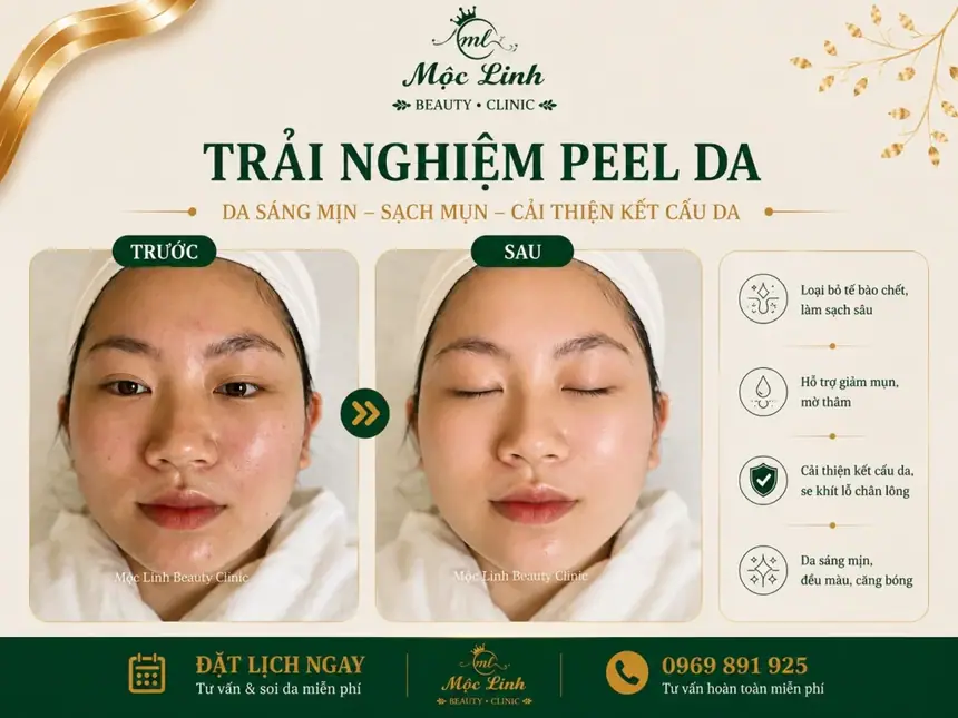 Peel Da Hải Phòng – Làn Da Cần Được Làm Mới Và Chăm tại Thẩm Mỹ Mộc Linh - hình 7