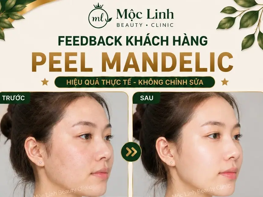 Peel Da Hải Phòng – Làn Da Cần Được Làm Mới Và Chăm tại Thẩm Mỹ Mộc Linh - hình 1