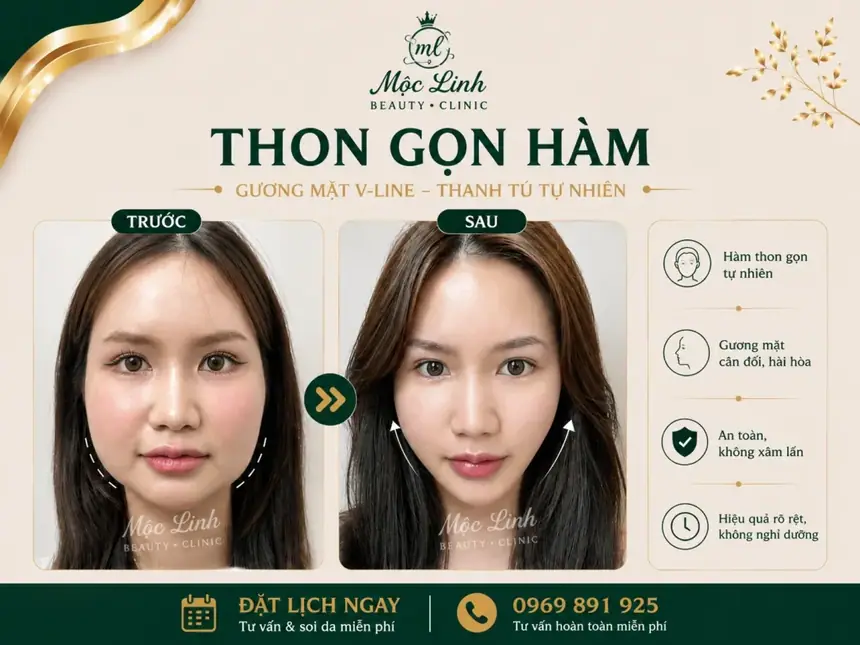 Tiêm Thon Gọn Hàm Hải Phòng tại Thẩm Mỹ Mộc Linh - hình 7