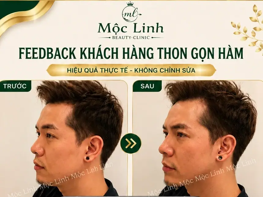 Tiêm Thon Gọn Hàm Hải Phòng tại Thẩm Mỹ Mộc Linh - hình 2