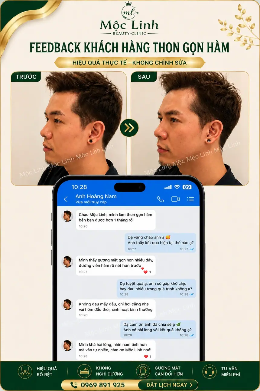 Tiêm Thon Gọn Hàm Hải Phòng tại Thẩm Mỹ Mộc Linh - hình 5