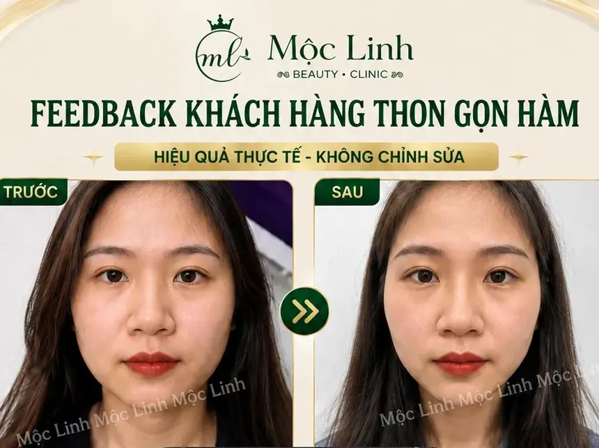 Tiêm Thon Gọn Hàm Hải Phòng tại Thẩm Mỹ Mộc Linh - hình 1