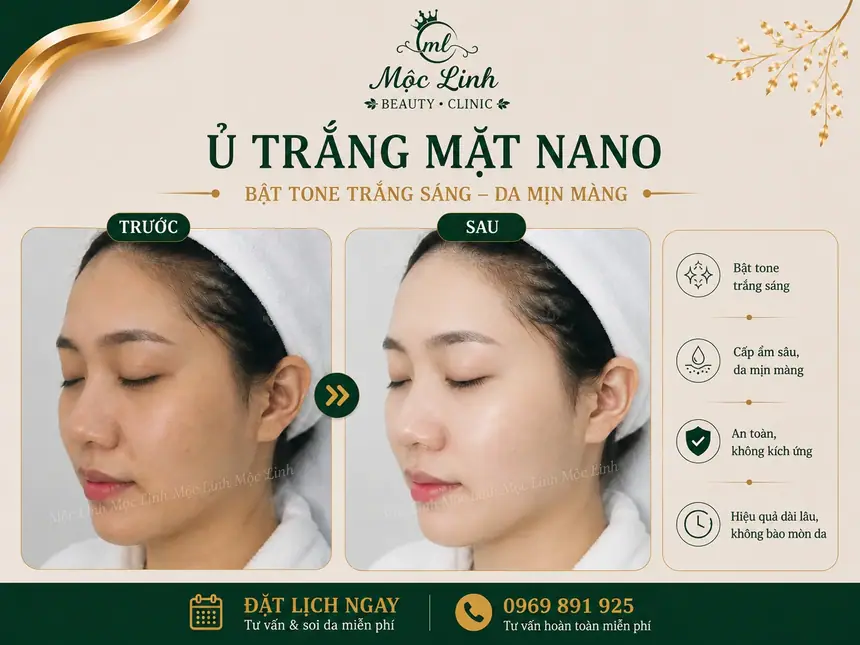 Kết quả ủ trắng mặt nano tại Thẩm Mỹ viện Mộc Linh
