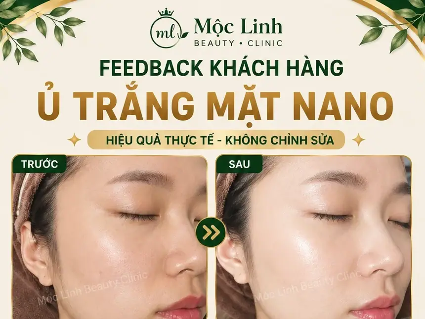 Ủ Trắng Mặt Nano Hải Phòng – Khi Làn Da Xỉn Màu Cần tại Thẩm Mỹ Mộc Linh - hình 2