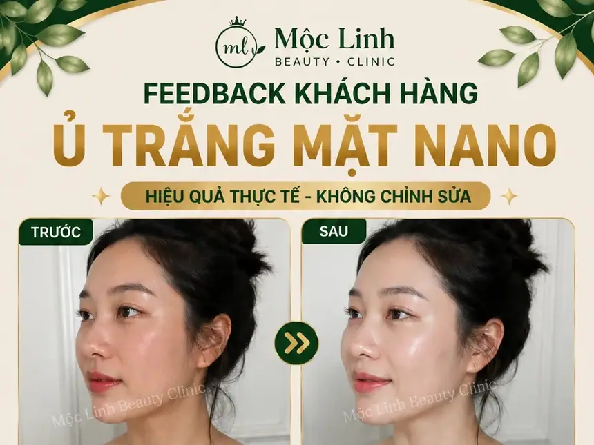 Ủ Trắng Mặt Nano Hải Phòng – Khi Làn Da Xỉn Màu Cần tại Thẩm Mỹ Mộc Linh - hình 1