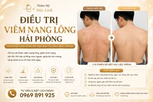 Điều Trị Viêm Nang Lông Hải Phòng – Giải Pháp Cho Vùng Da Thô Ráp Và Lông Mọc Ngược