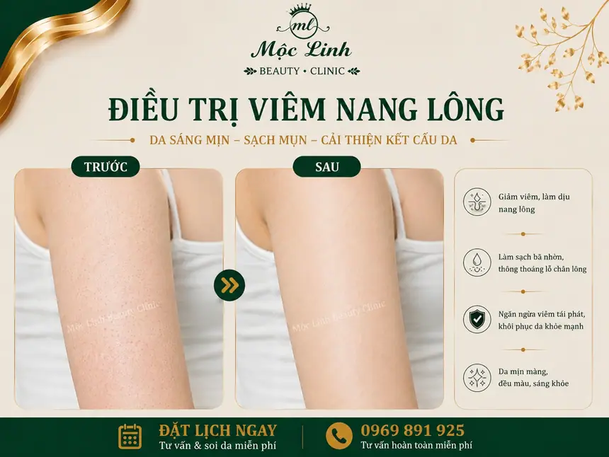 Hình ảnh thực tế dịch vụ điều trị viêm nang lông tại Hải Phòng