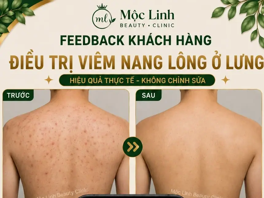 Điều Trị Viêm Nang Lông Hải Phòng – Giải Pháp Cho Vùng tại Thẩm Mỹ Mộc Linh - hình 2