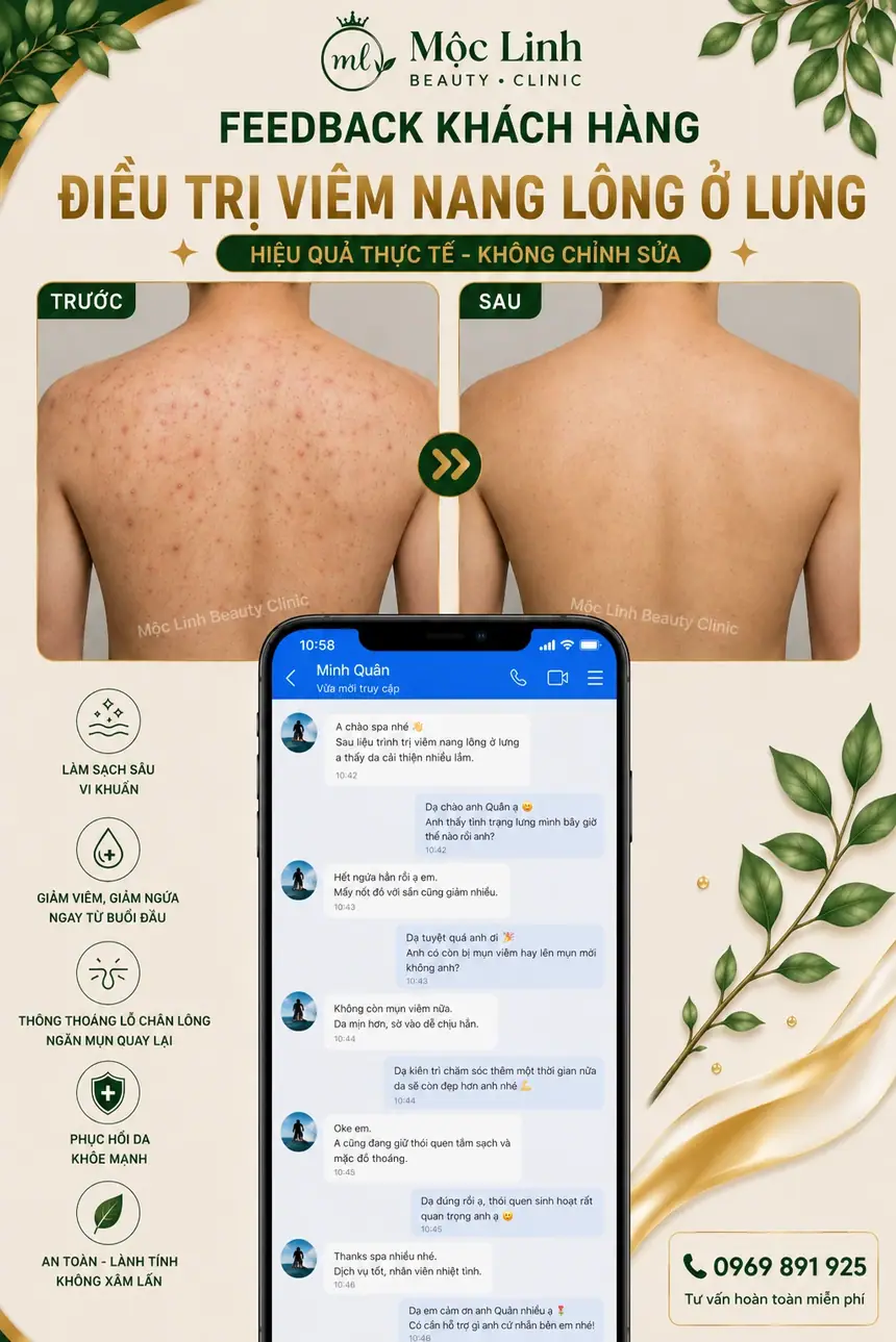 Điều trị viêm nang lông công nghệ cao tại Mộc Linh Hải Phòng
