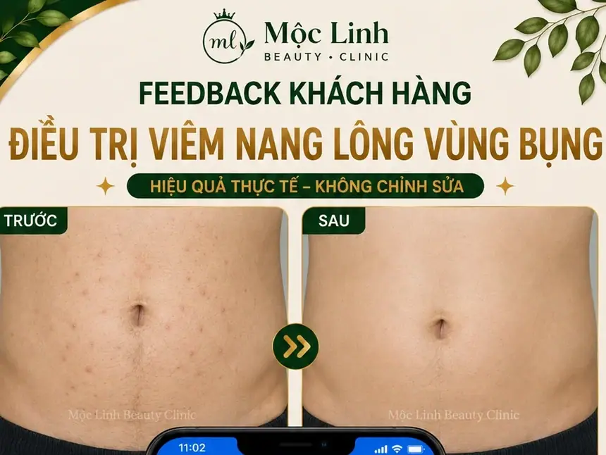 Điều Trị Viêm Nang Lông Hải Phòng – Giải Pháp Cho Vùng tại Thẩm Mỹ Mộc Linh - hình 1