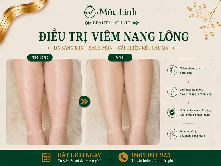Kết quả điều trị viêm nang lông tại Thẩm Mỹ viện Mộc Linh
