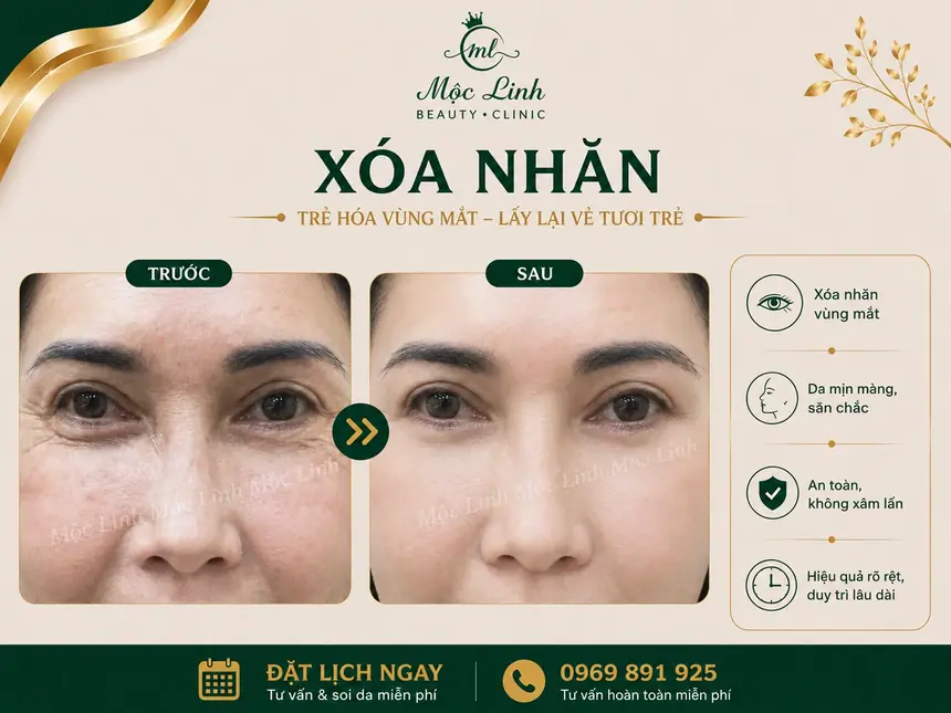 Xóa Nhăn Hải Phòng tại Thẩm Mỹ Mộc Linh - hình 4