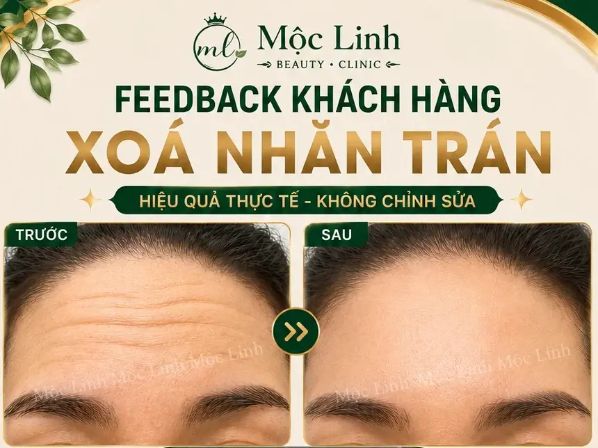 Xóa Nhăn Hải Phòng tại Thẩm Mỹ Mộc Linh - hình 2