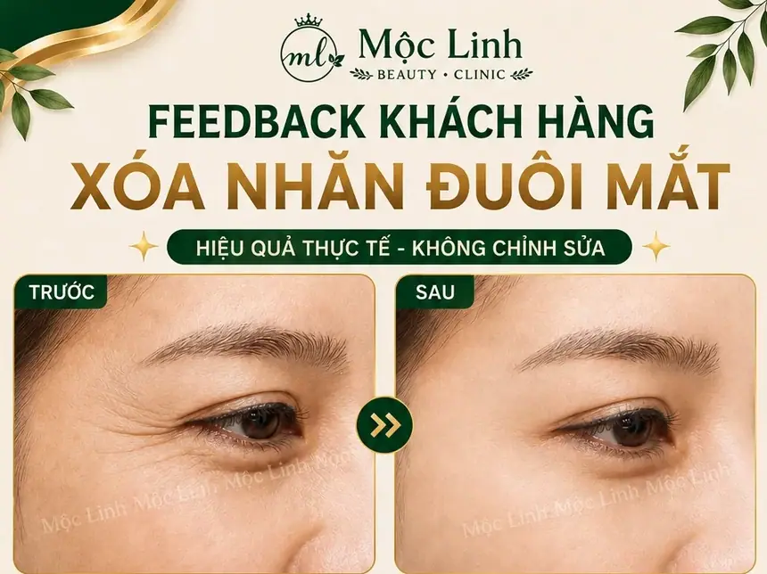 Xóa Nhăn Hải Phòng tại Thẩm Mỹ Mộc Linh - hình 1