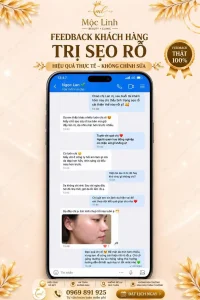 Sẹo rỗ có đầy lại được không? Các cách xử lý tại Hải Phòng
